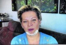 Deputada já admite que lesões podem ser resultado de queda