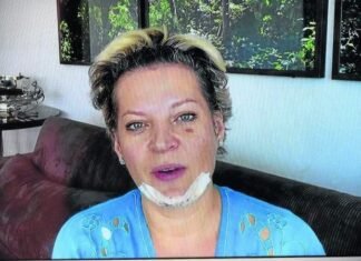 Deputada já admite que lesões podem ser resultado de queda